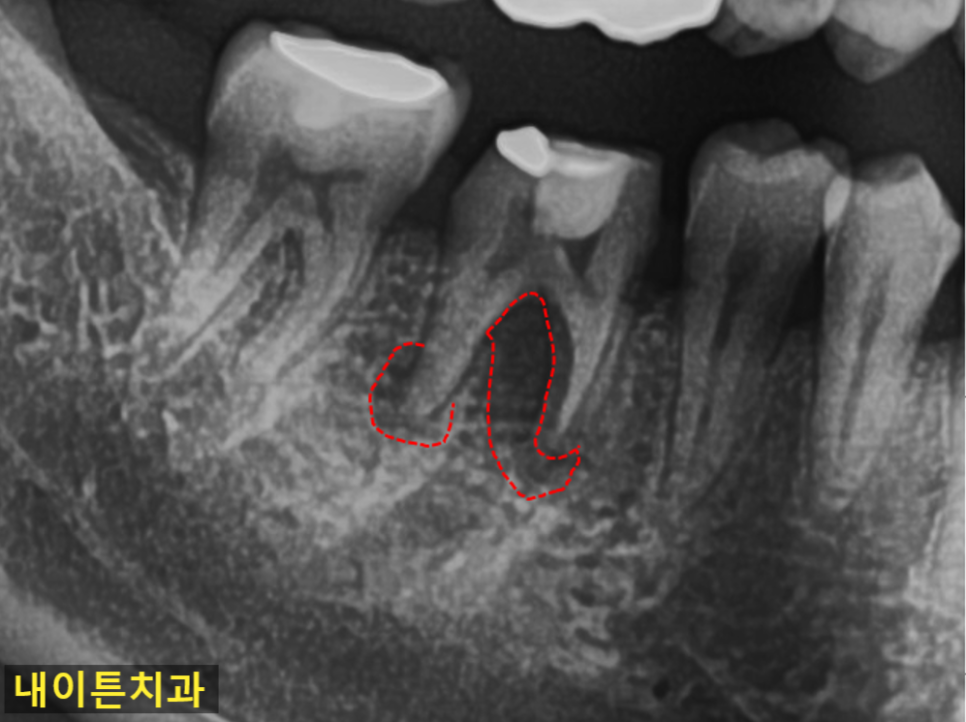 Treatment case image 1