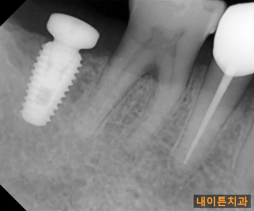 Treatment case image 3