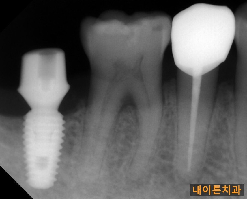 Treatment case image 5
