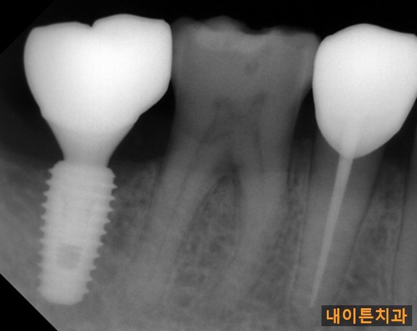 Treatment case image 6