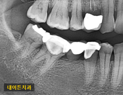 Treatment case image 1