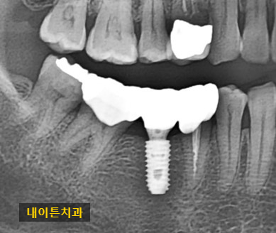 Treatment case image 4