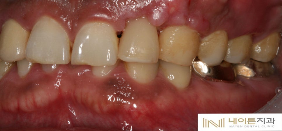 Treatment case image 14