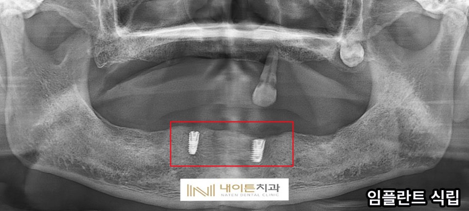Treatment case image 2