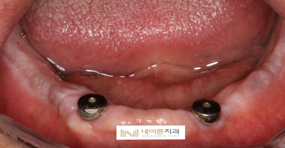 Treatment case image 4