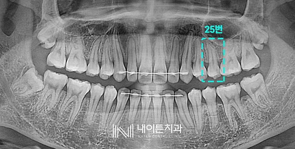 Treatment case image 2