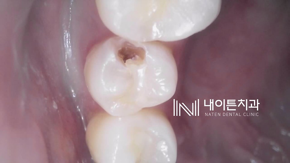 Treatment case image 4
