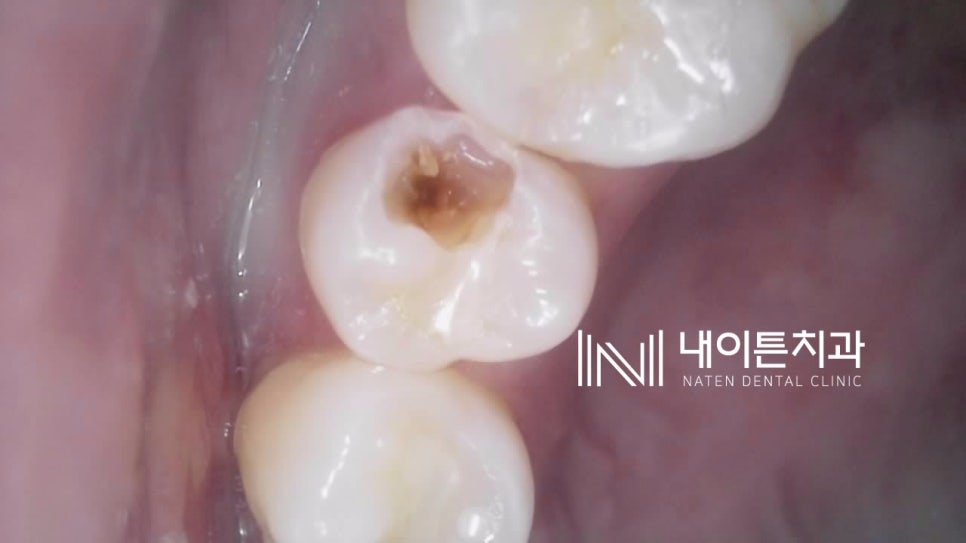 Treatment case image 6