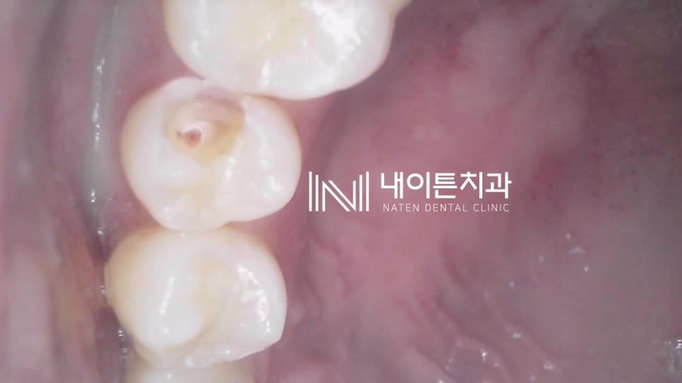 Treatment case image 12