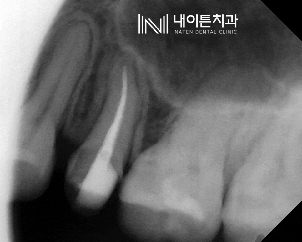 Treatment case image 14