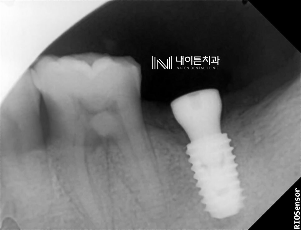 Treatment case image 4