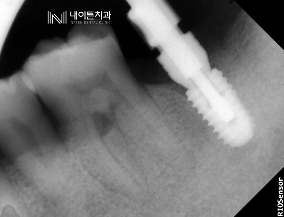 Treatment case image 5
