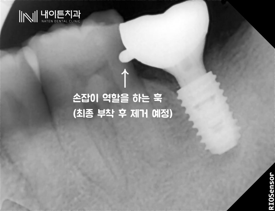 Treatment case image 6