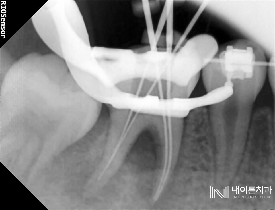 Treatment case image 2