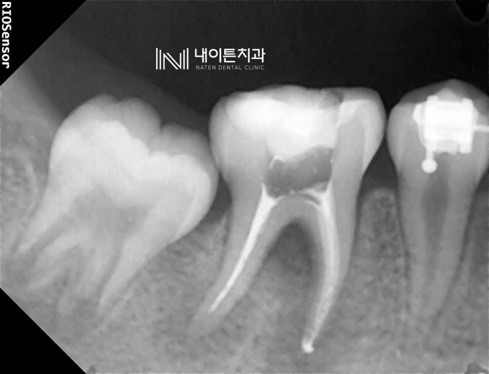 Treatment case image 4