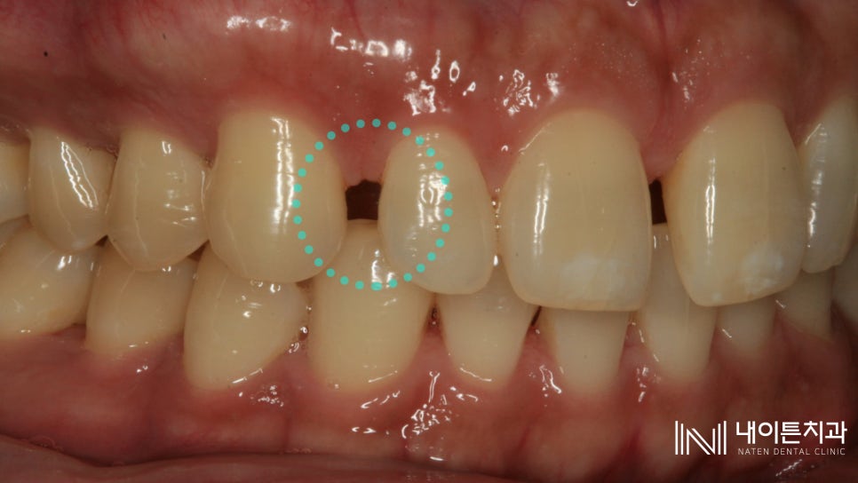 Treatment case image 2