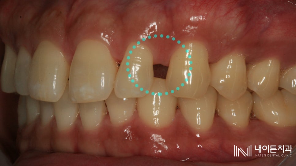Treatment case image 3