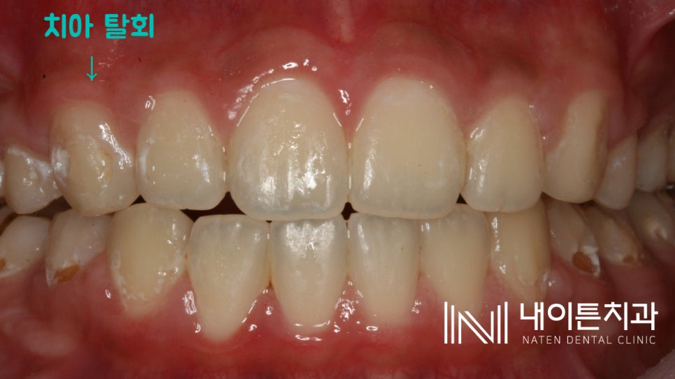 Treatment case image 1