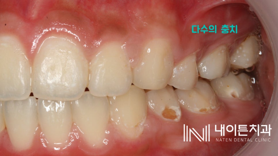 Treatment case image 3