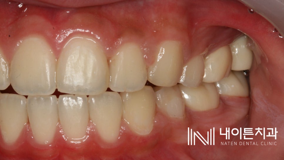 Treatment case image 11