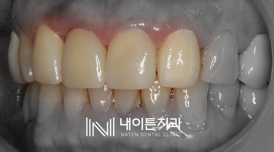 Treatment case image 6