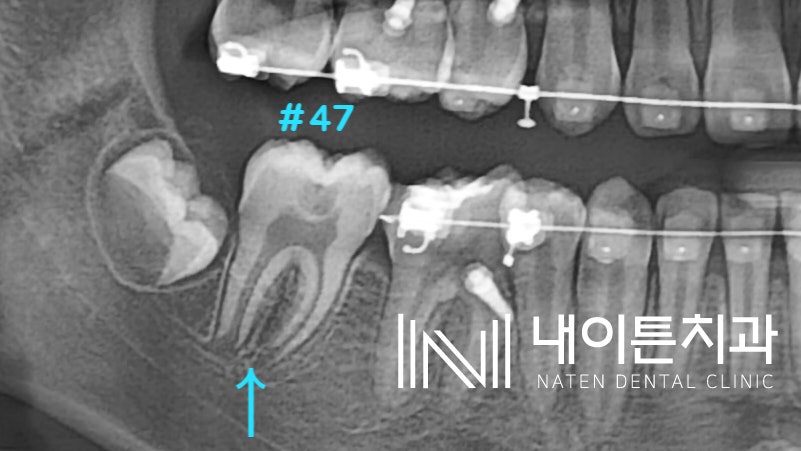 Treatment case image 1