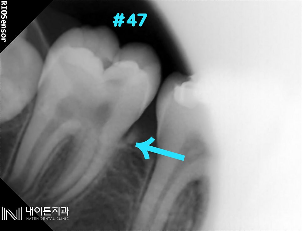 Treatment case image 2