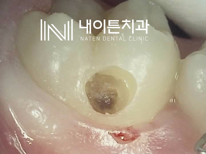 Treatment case image 5
