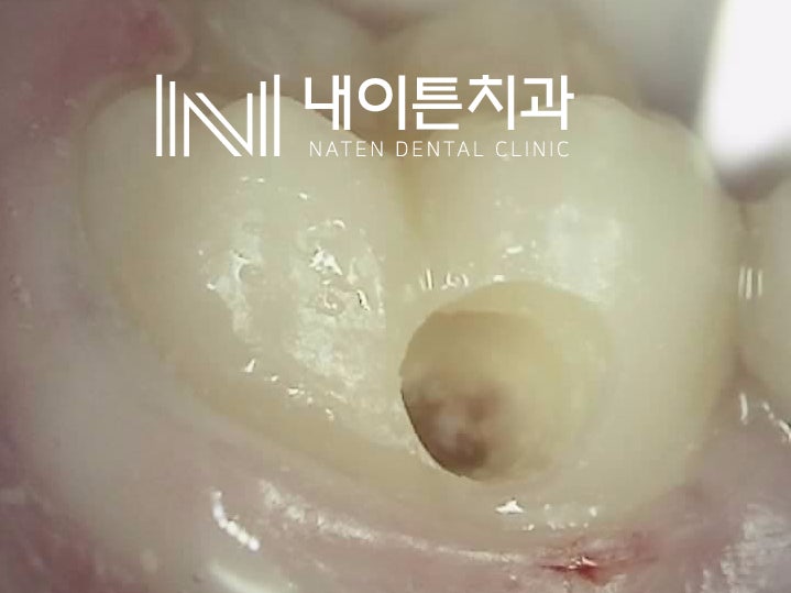 Treatment case image 6