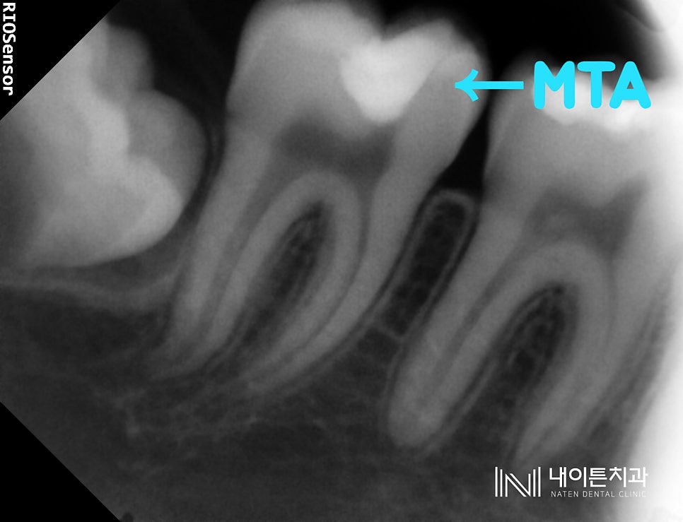 Treatment case image 8