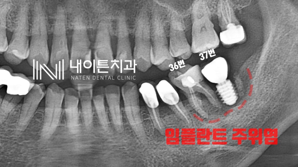 Treatment case image 1