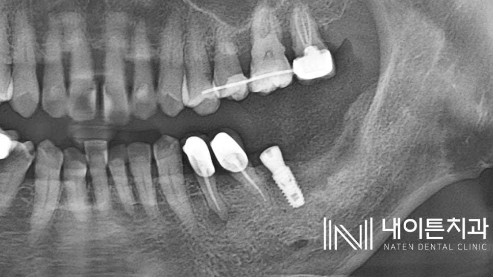 Treatment case image 4