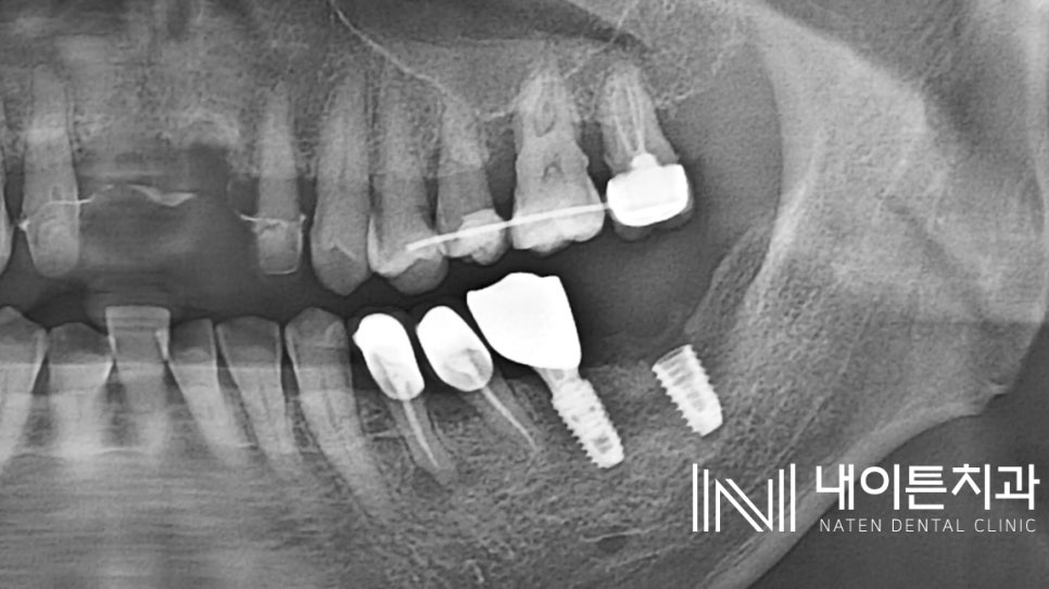 Treatment case image 5