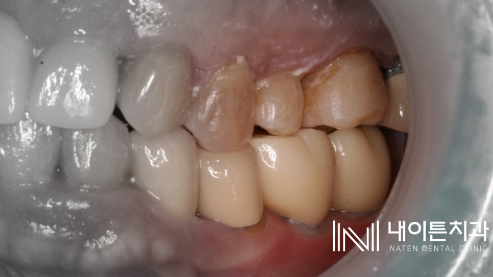 Treatment case image 9