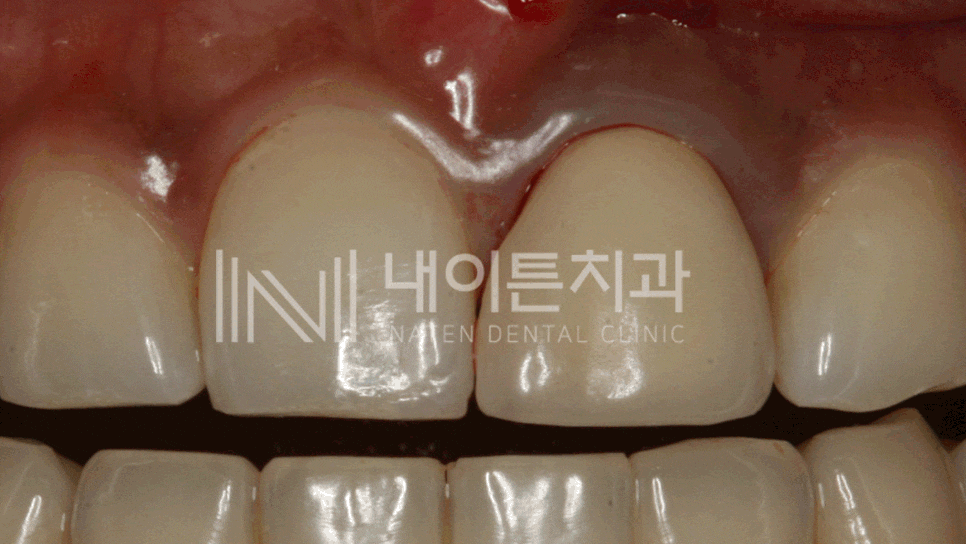 Treatment case image 1