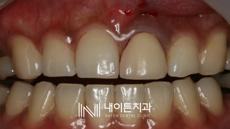 Treatment case image 2
