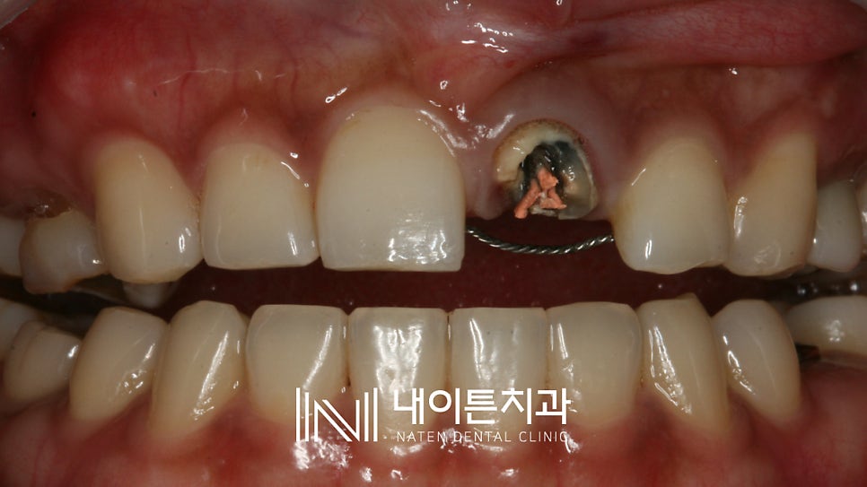 Treatment case image 4