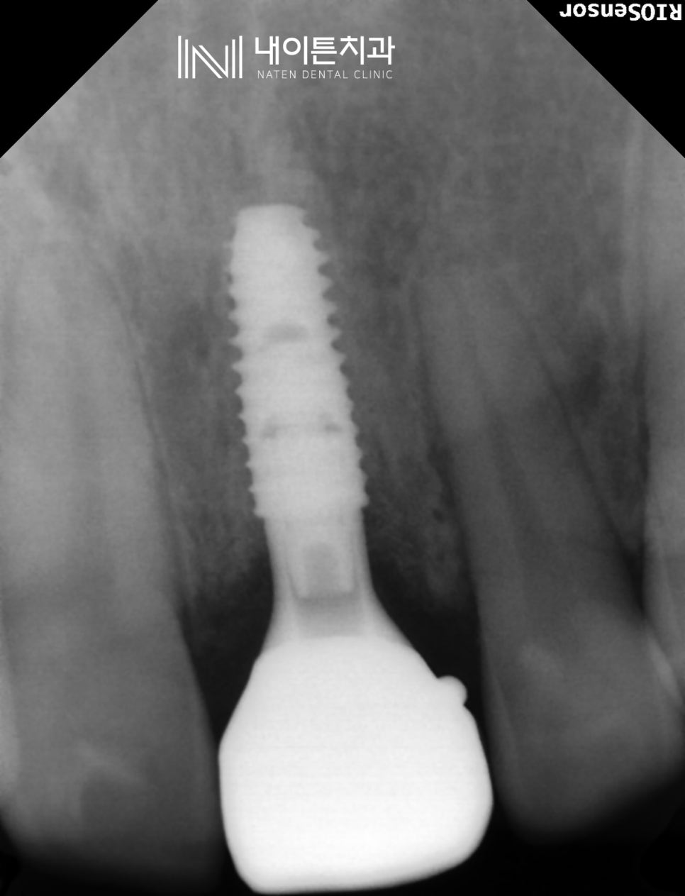 Treatment case image 10