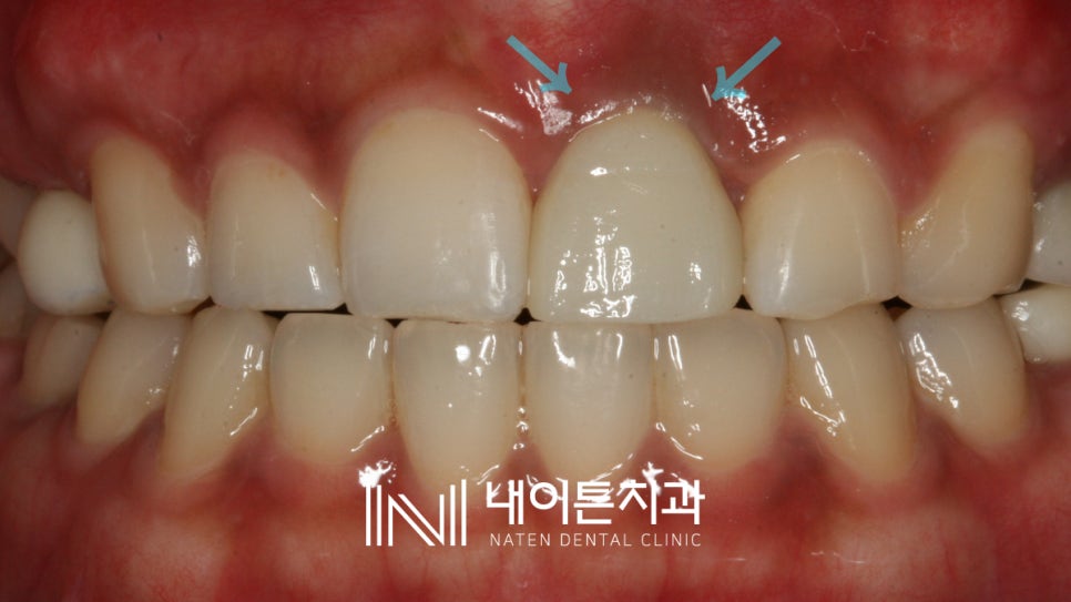 Treatment case image 11