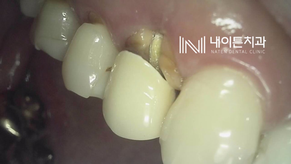 Treatment case image 3