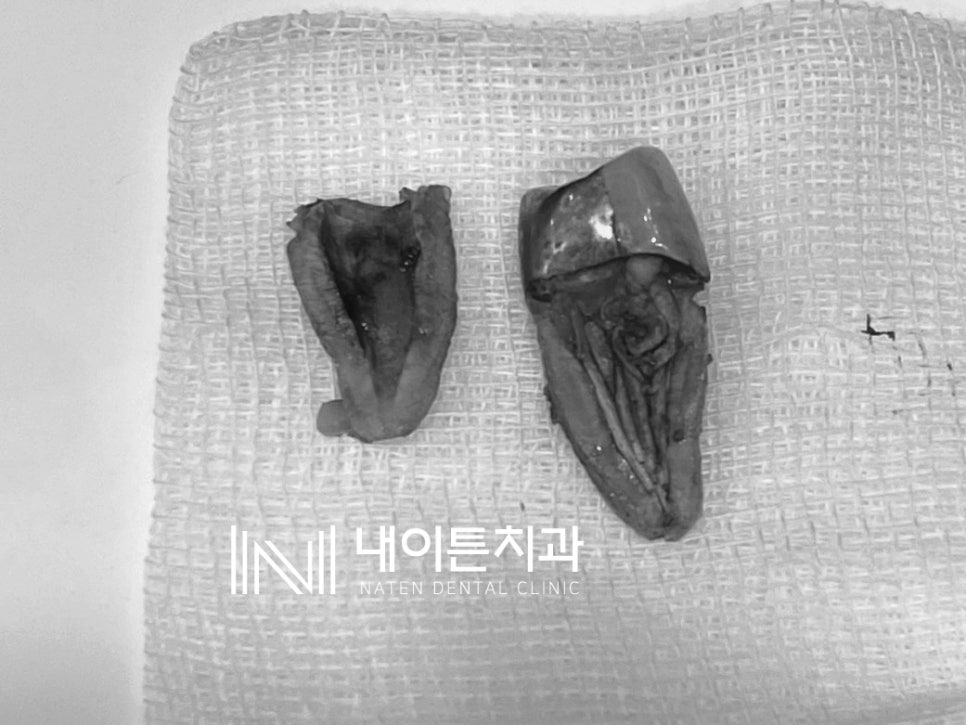 Treatment case image 5
