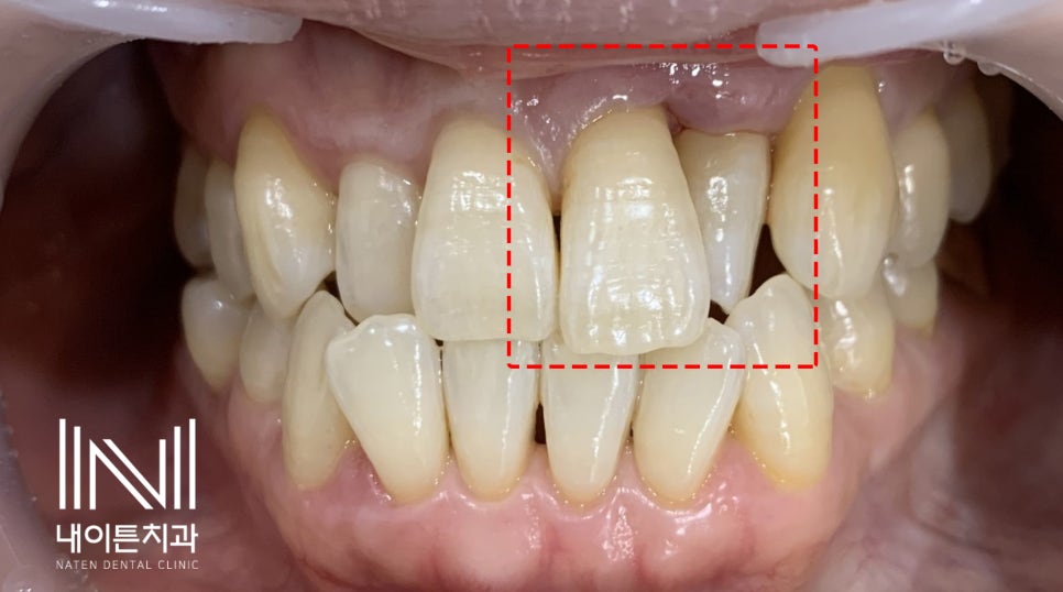 Treatment case image 3