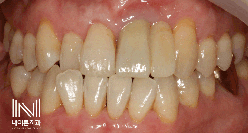 Treatment case image 14
