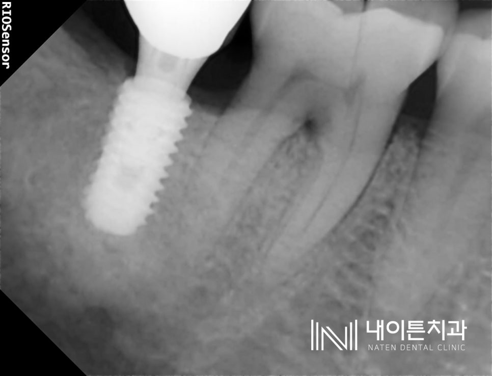 Treatment case image 2