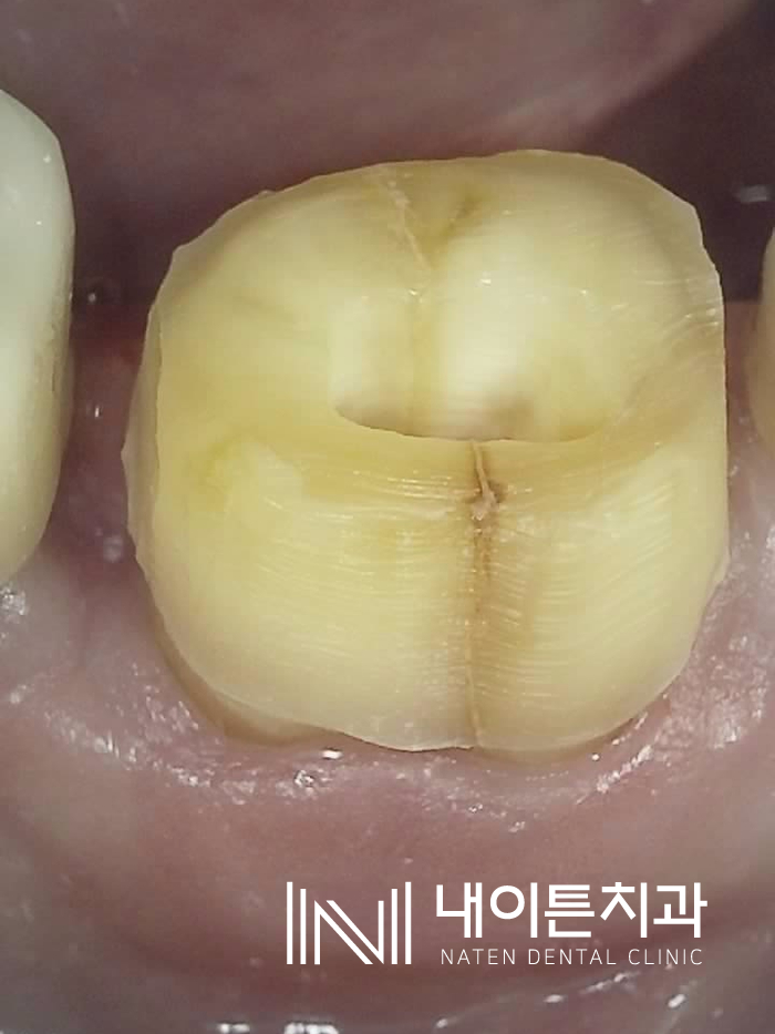 Treatment case image 3