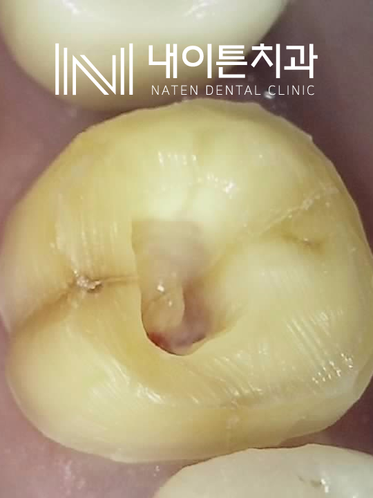Treatment case image 4