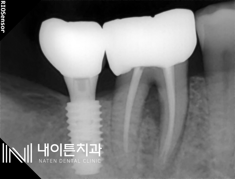 Treatment case image 3