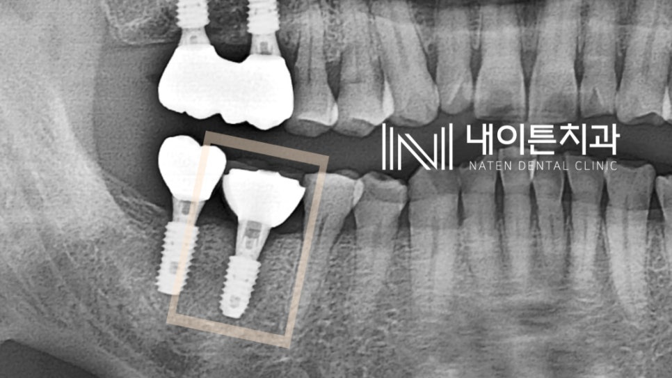 Treatment case image 4