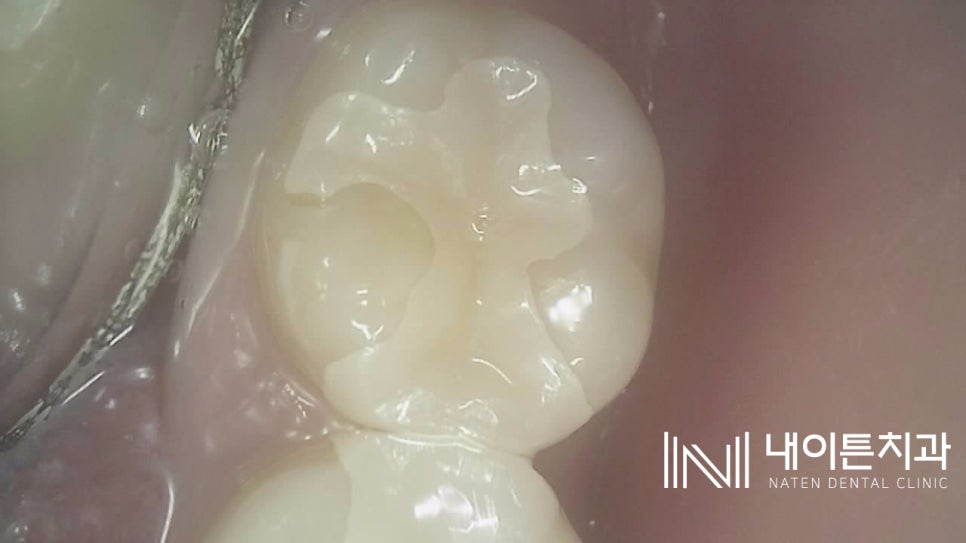Treatment case image 2
