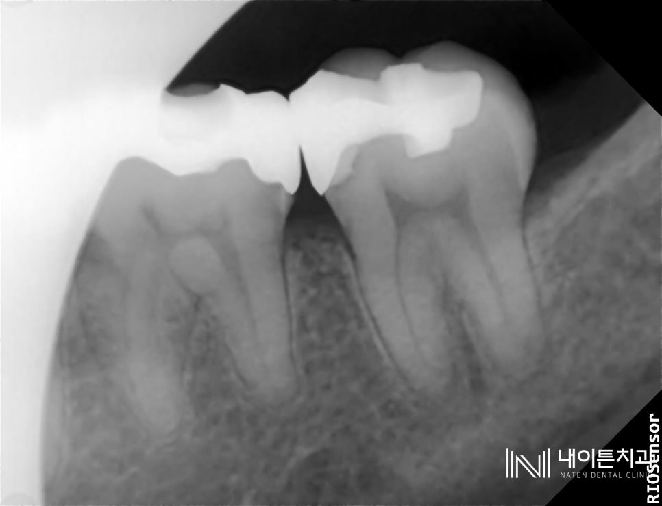 Treatment case image 3